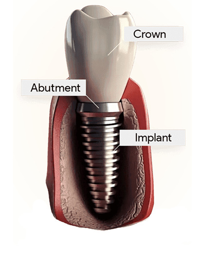 implant-img