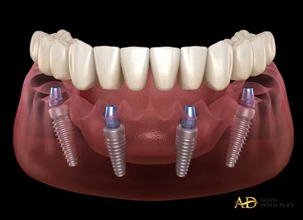 all-on-four-implant